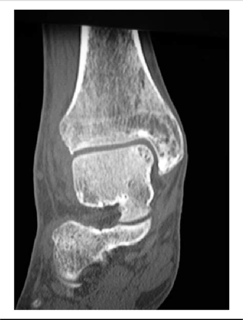 Figure 3 From Comparison Of Osteochondral Autografts And Allografts For