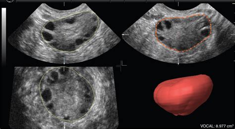 Normal Ovary Transvaginal Ultrasound