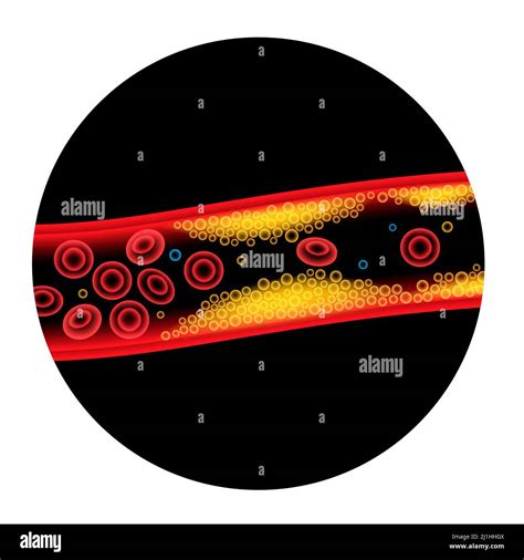 Cholesterol In Human Blood Vessels Illustration Stock Photo Alamy