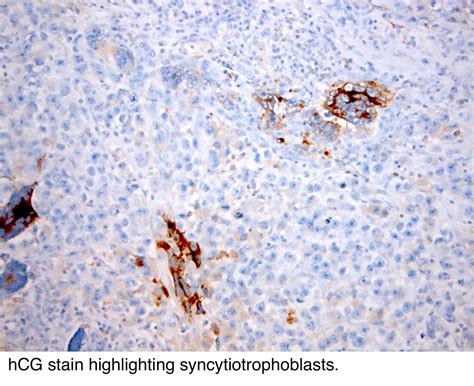 Seminoma Cytology