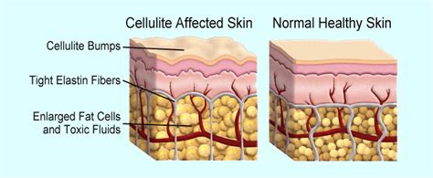 4 Ways the Best Cellulite Treatment - Cellulite Treatment News