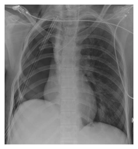 Supine Portable Chest Radiograph Obtained 12 Hours After Resection Of