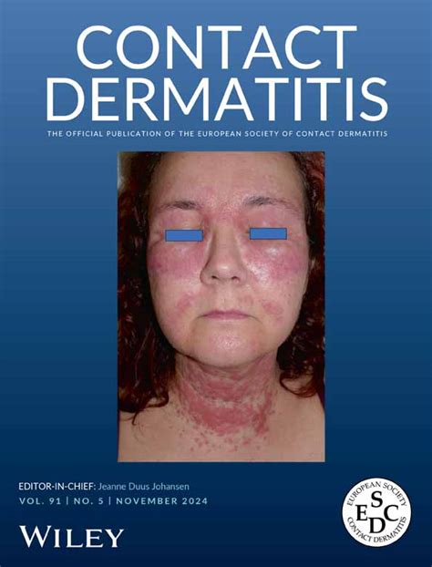 Overview Contact Dermatitis Wiley Online Library