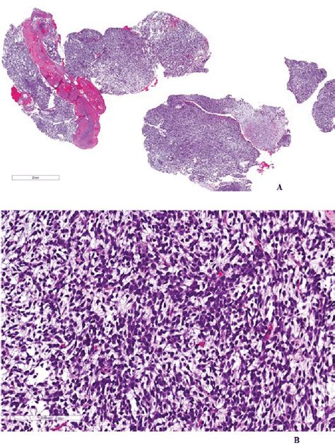 A A 49 Year Old Man With Metastatic Myxoid Liposarcoma Histopathology