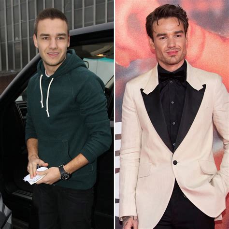 Did Liam Payne Ever Get Plastic Surgery See Photos Of His