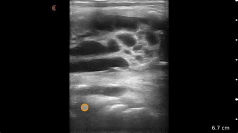 Bakers Cyst Ultrasound Image Interpretation Youtube