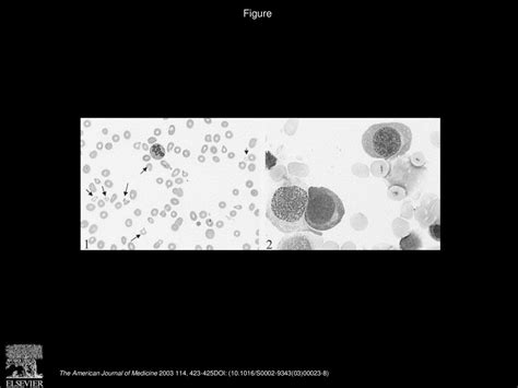 Schizocytosis In Pernicious Anemia Mimicking Thrombotic