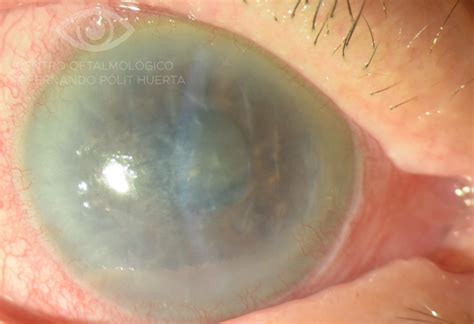 Distrofia De Fuchs Con Edema Corneal Preoperatorio Queratoplastia