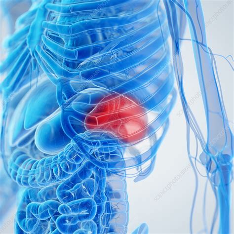 Inflamed Spleen Illustration Stock Image F038 4309 Science Photo Library