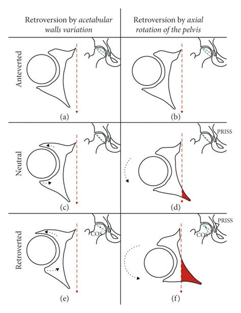 Simplified hip illustrations explaining the possible mechanisms of ...