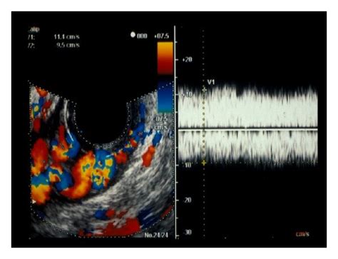 The Image Shows Anterior Branch Dominant Esophageal Varices Observed