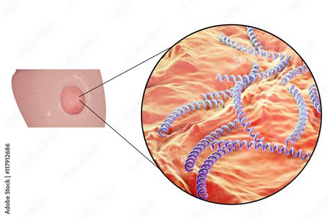 Syphilitic Ulcer Ulcus Durum And Close Up View Of Syphilis Bacteria