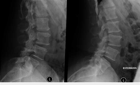 Preoperative Flexion And Extension Of Lumbar Spine Left Image Lateral