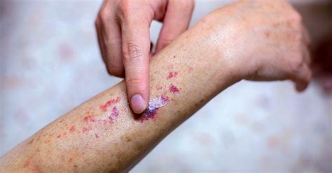 Purpuric Rash Causes Pictures And When To Get Medical Help