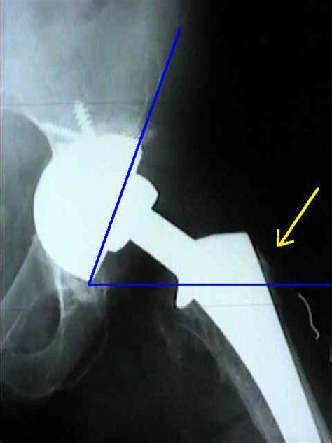 Dislocation Of Tha Wheeless Textbook Of Orthopaedics