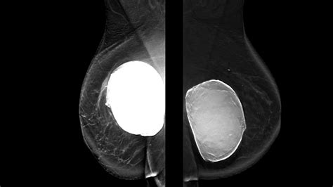 Baker Iv Capsular Contracture Implant Explantation And Breast