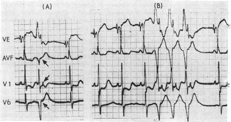 A Study Using Conventional Leads Of Retrograde Atrial Activation