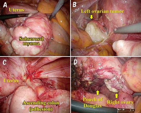 Findings During First Laparoscopic Surgery Laparoscopic Subserosal