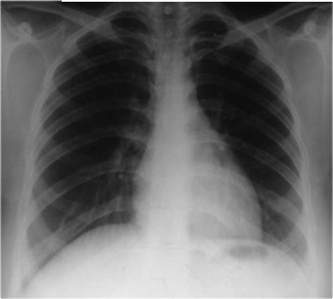 E Chest Radiograph Posteroanterior View Showing Complete Resolution