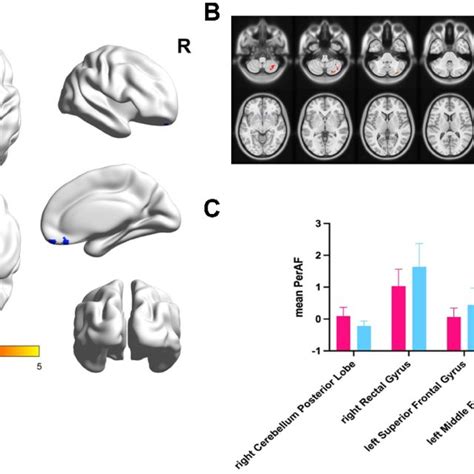 Comparison Of The Peraf Signal In Patients Osa And Hcs A And B The