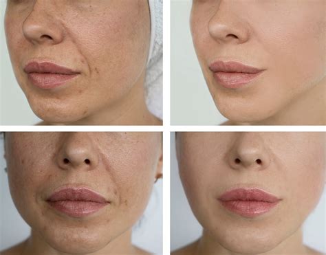 Ipl Skin Rejuvenation La Lips®