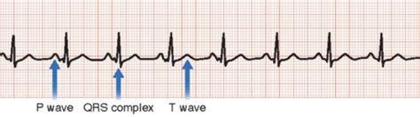 Medsurg Chapter Cardiac Dysrhythmia Examples Flashcards Quizlet