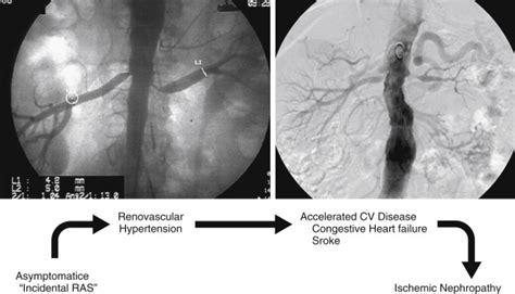 Renovascular Hypertension And Ischemic Nephropathy Thoracic Key