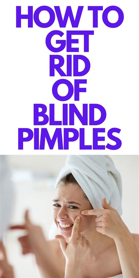 How To Get Rid Of Blind Pimples Looking To Get Rid Of Some Blind Pimples Here Are Ways To Get