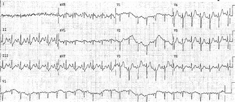 ECG Case 101: Lown-Ganong-Levine (LGL) syndrome - Manual of Medicine