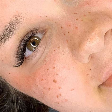 Freckle Tattoos Before And After Pictures Gallery Best Examples Artofit