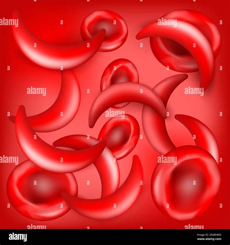 Sickle Cell Disease Scd Normal Erythrocytes And Sickle Cells On Blood