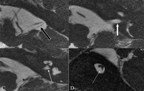 A D Cochlear Nerve Deficiency Axial D Fiesta Images A C Show A