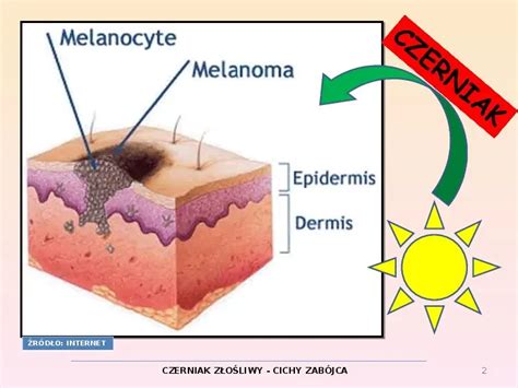 Prezentacja Czerniak Z O Liwy Wiat Prezentacji