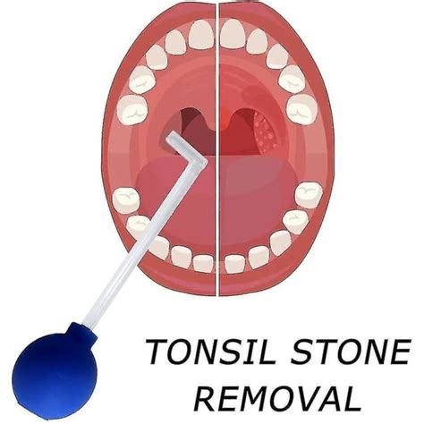 Tonsil Stone Remover Vakuum Tonsil Stone Removal Kit Verktyg Tonsil