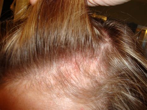 Hairline Rashes Pictures Photos