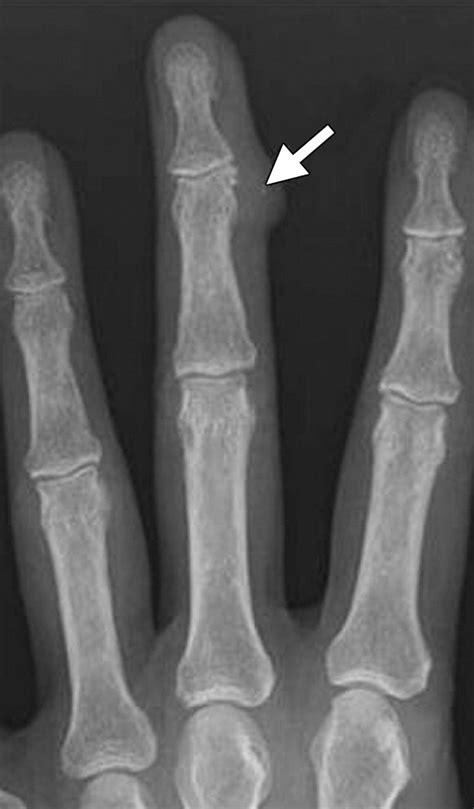 Diagnostic Imaging Of Benign And Malignant Osseous Tumors Of The Fingers Radiographics