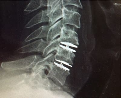 Artificial disc replacement surgery of spine in Mumbai – D Spine