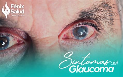 ¿cómo Identificar Los Síntomas Del Glaucoma Centro Clínico Fenix Salud