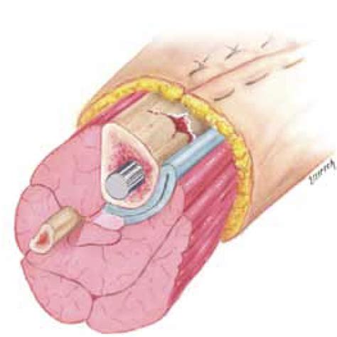 Infuse Bone Graft – Welcome to SYS Medtech International Pvt. Ltd.