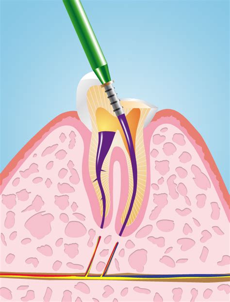 Endodontie Wurzelkanalbehandlung Zahngesundheit Hemau