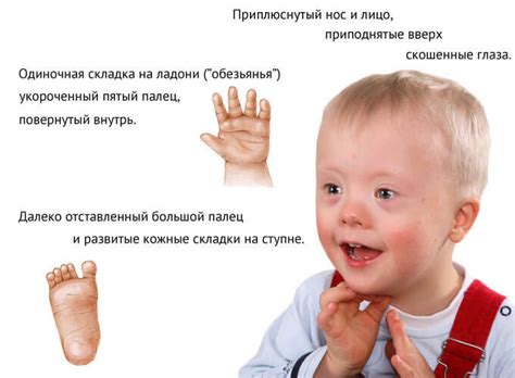 A síndrome de Down: causas, sintomas e comorbidades