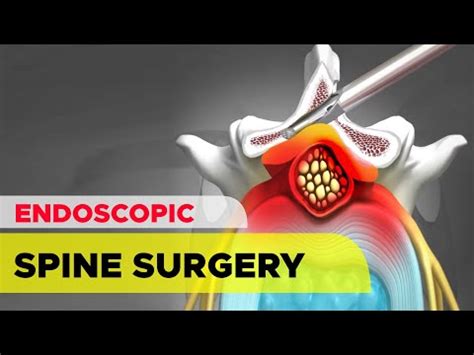 Endoscopic Spine Surgery The Unilateral Biportal Endoscopic UBE