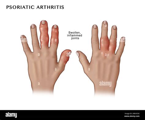 Psoriatic arthritis nails hi-res stock photography and images - Alamy