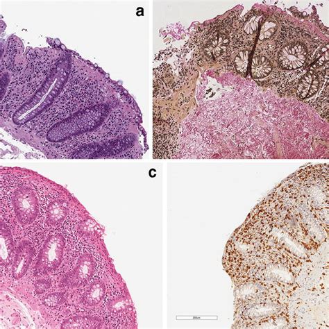 A Collagenous Colitis He Stained Slide The Surface Epithelium Is Download Scientific Diagram