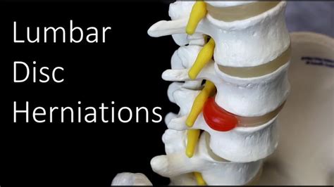 Lumbar Disc Herniations Causes And Treatment Disk Herniation