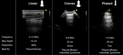 Lung Ultrasound Basics Flashcards Quizlet