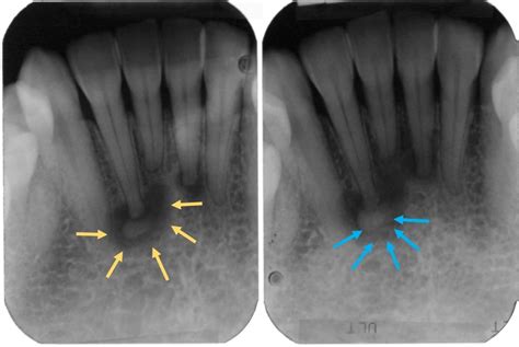 Focal Cemento Osseous Dysplasia