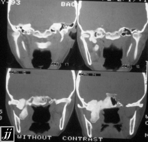 Radioogle Ent Sphenoidal Bone Fibrous Dysplasia