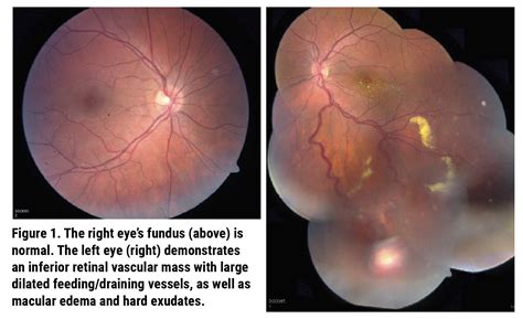 September 2023 Wills Eye Resident Case Series