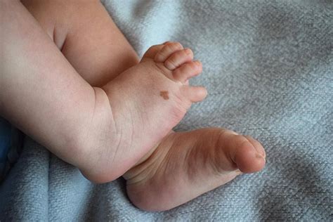 Birthmarks In Babies Causes Types And Treatment